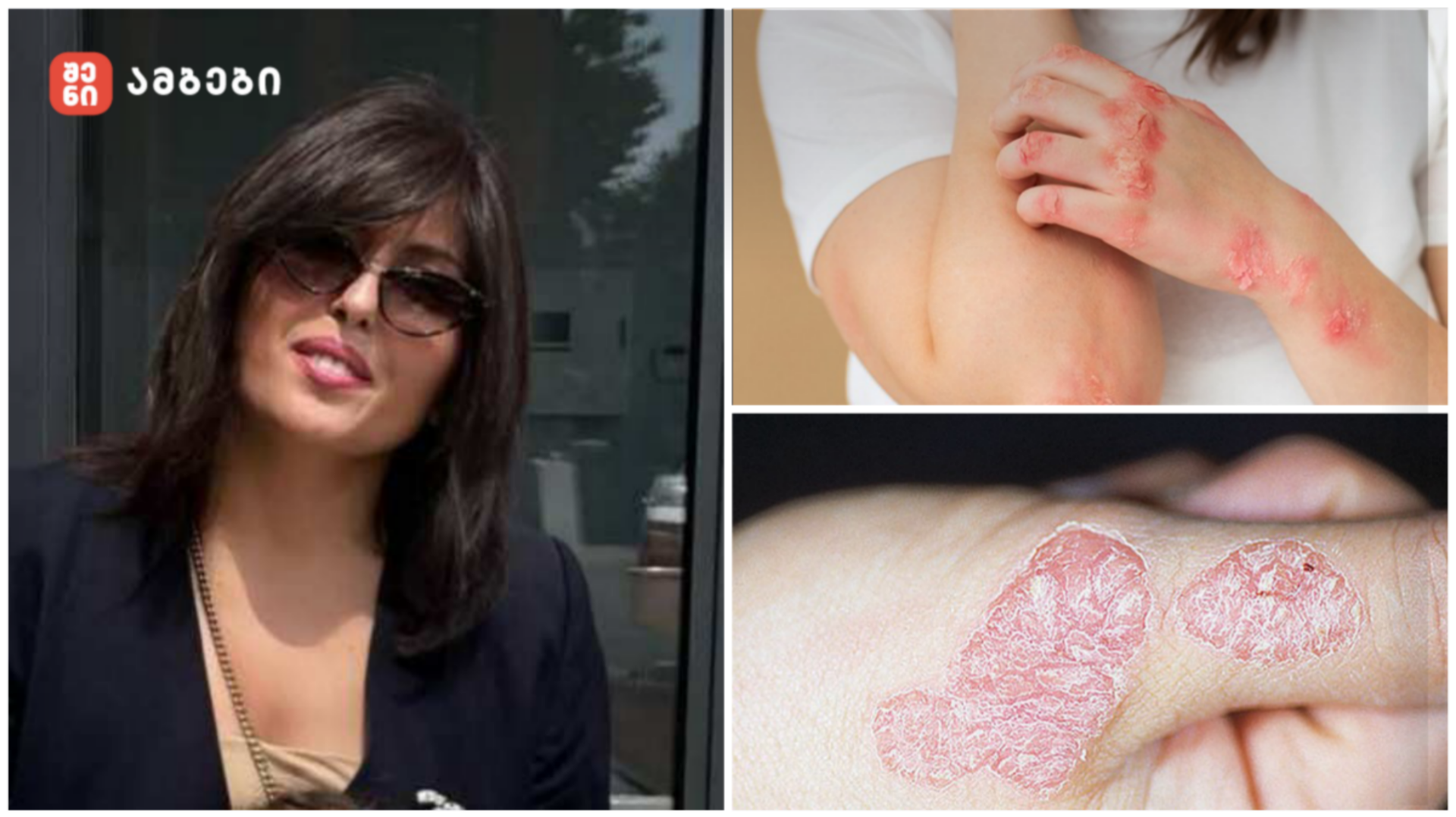 Keti pircxalava psoriazi