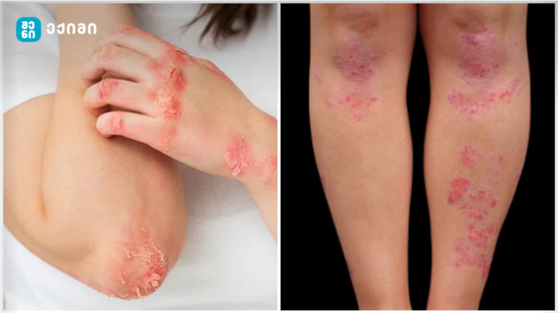 Psoriazi