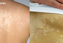 დაავადების ადრეული ნიშნების იგნორირება ხშირად იწვევს დიაგნოზის დაგვიანებას და მკურნალობის გართულებას – კანის კიბოს ორი ნიშანი, რომლებსაც ხშირად ყურადღებას არ აქცევენ ვიტილიგო