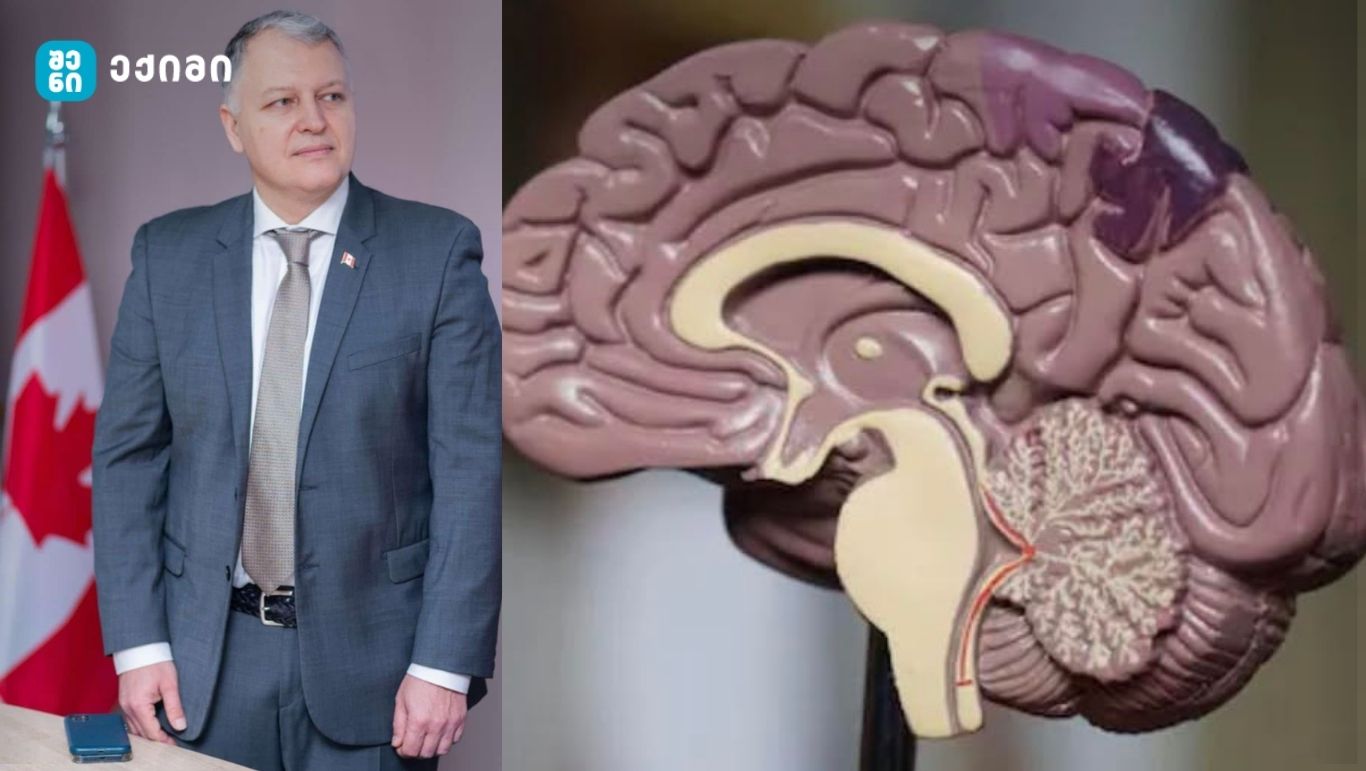 Alzheimer-ის დაავადება: მხოლოდ მეხსიერების დაკარგვა არ არის