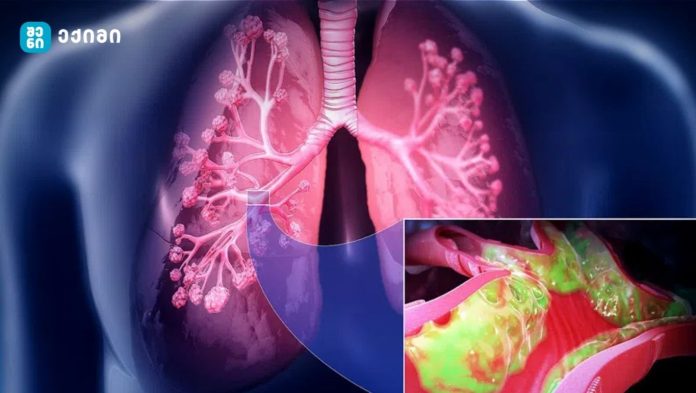 რა არის ბრონქოექტაზია?