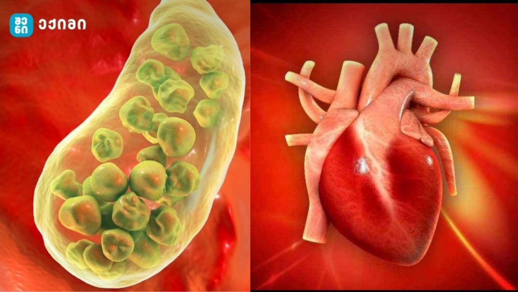 როგორ შეიძლება გულის შეტევა გამოიწვიოს ნაღვლის ბუშტის პრობლემებმა?