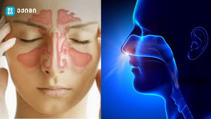 cxviridan suntqvis gadzneleba ცხვირიდან სუნთქვის გაძნელება - რატომ არ უნდა უგულებელვყოთ და როგორ ვუმკურნალოთ სწორად?