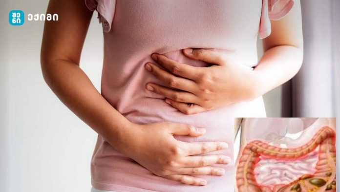 მუცლის შებერილობა-ბუნებრივი საშუალება