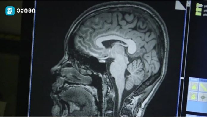 simsuqne da tvini კვლევა - სიმსუქნე და ტვინი - სიმსუქნე შესაძლოა, თავის ტვინის ზომის შემცირებას იწვევდეს