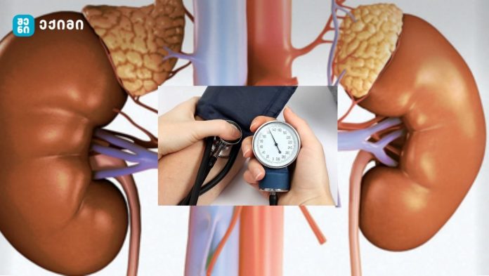რა კავშირშია მაღალ არტერიულ წნევასა და თირკმელს შორის