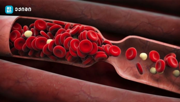 თავიდან ავიცილოთ გართულებები – თრომბის ნიშნები, რომლებიც უყურადღებოდ არ უნდა დავტოვოთ