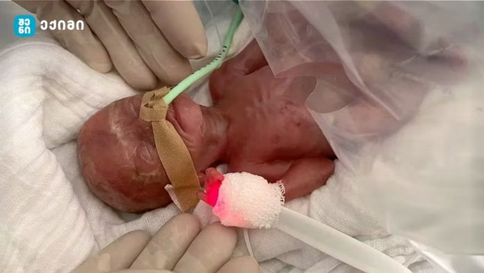 გადაარჩინეს ბავშვი, რომელიც დაბადებისას 300 გრამს იწონიდა