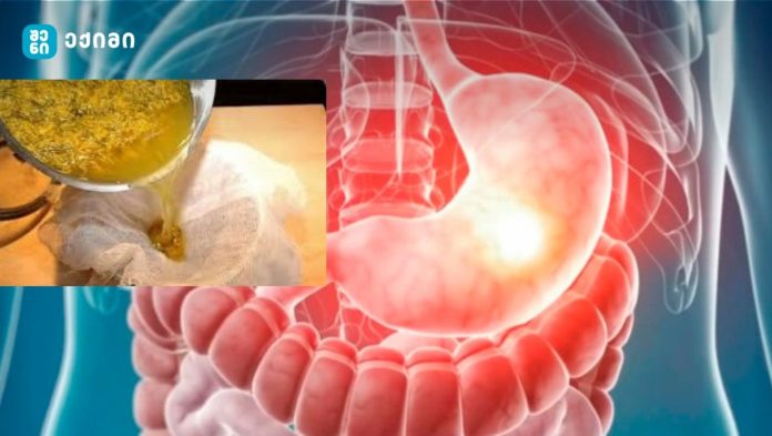 დაივიწყეთ გასტრიტი და გულძმარვა ამ ძლიერი წამლის დახმარებით! – გასტრიტის სამკურნალო ბუნებრივი 5 საშუალება