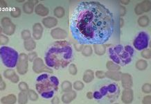 ეოზინოფილების მომატება, ანუ ეოზინოფილია, სხვადასხვა ფაქტორს შეიძლება უკავშირდებოდეს. ყველაზე ხშირი მიზეზებ ეოზინოფილების მომატება, ანუ ეოზინოფილია, სხვადასხვა ფაქტორს შეიძლება უკავშირდებოდეს. ყველაზე ხშირი მიზეზებ