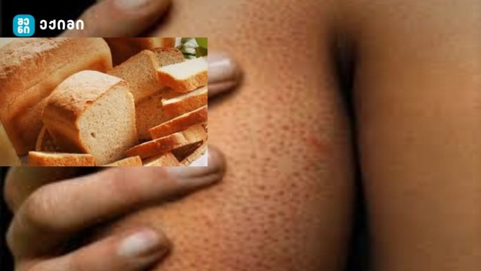 “გლუტეინი” – გაეცანით 8 მიზეზს, იქნებ თქვენც გაქვთ გლუტეინის აუტანლობა