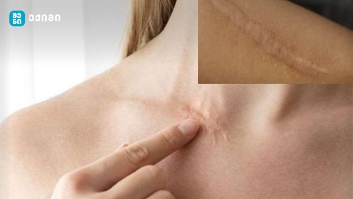 ინოვაციური სამკურნალო საშუალება - შექმეს კრემი, რომლის მეშვეობითაც ნაიარევი გაქრება