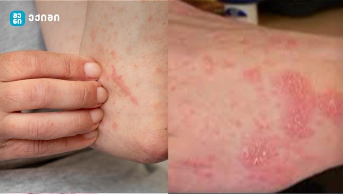 მუნი - რა უნდა ვიცოდეთ, რომ დაავადება თავიდან ავიცილოთ, განკურნება მიიღწევა სამი პირობის დაცვით