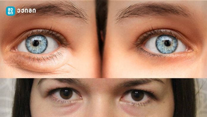 თვალის ქვეშ შეშუპება – მთავარი მიზეზები და რა შეიძლება ის ნიშნავდეს