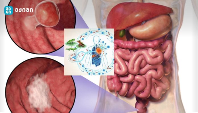 ახალი კვლევა - იაპონური ხის ბაყაყის ნაწლავიდან გამოყოფილმა ბაქტერიამ მსხვილი ნაწლავის კიბო სრულიად გაანადგურა