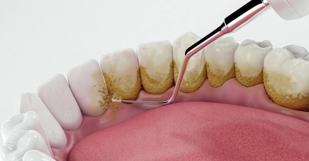 რატომ არის პირის ღრუს ჯანმრთელობა ორგანიზმისთვის კრიტიკულად მნიშვნელოვანი? | sheniekimi.ge | შენი ექიმი