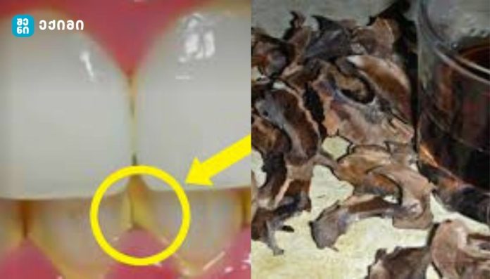 როგორ მოვიშოროთ ნადები 5 წუთში ბუნებრივად სტომატოლოგთან ვიზიტის გარეშე!