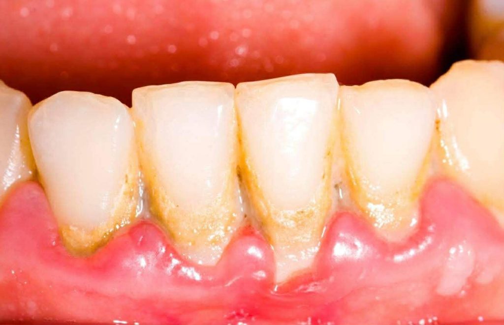 რატომ ვერ იწმინდება ნადების 80 % სახლში? | sheniekimi.ge | შენი ექიმი