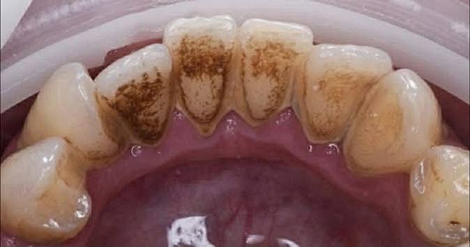 რატომ ვერ იწმინდება ნადების 80 % სახლში? | sheniekimi.ge | შენი ექიმი