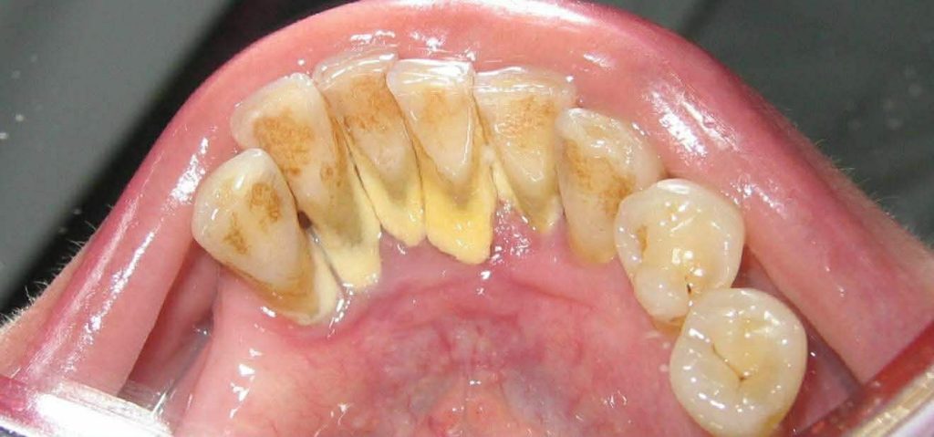 რატომ ვერ იწმინდება ნადების 80 % სახლში? | sheniekimi.ge | შენი ექიმი