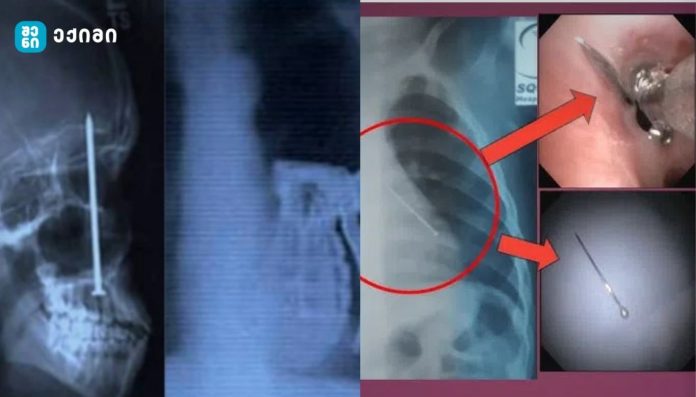 ერთმა პაციენტმა კბილებს შორის მოქცეული ლურსმნები შემთხვევით გადაყლაპა - ექიმებმა 2025 წელს პაციენტების სხეულიდან ამოღებული ყველაზე უჩვეულო საგნები დაასახელეს