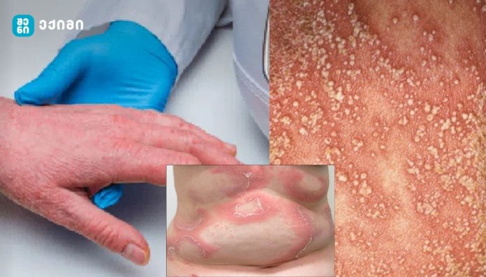 🔺როცა წონა აძლიერებს ტკივილს: სიმსუქნის როლი ფსორიაზულ დაავადებაში