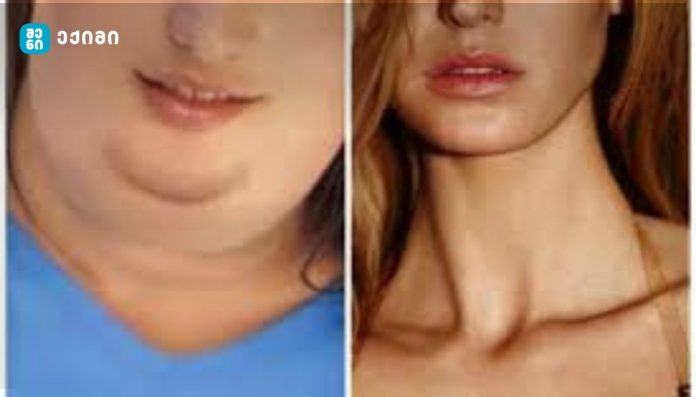 გსურთ მარტივად მოიცილოთ ღაბაბი და გაიმკვრივოთ სახის კონტური? მაშინ მიყევით ამ წეს