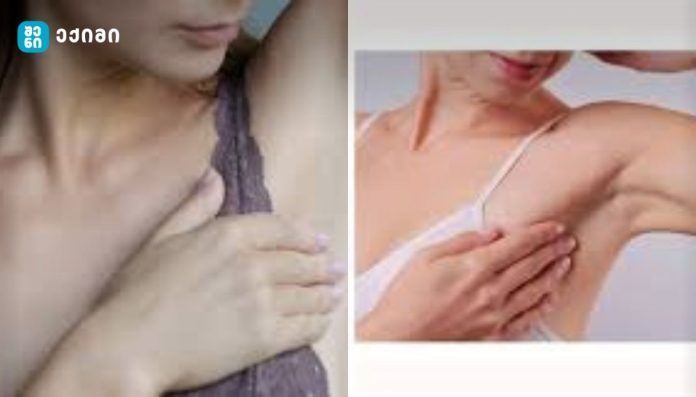 ლიმფური კვანძების გადიდება ყოველთვის სიმსივნეს არ ნიშნავს - იღლიის ლიმფური კვანძები: ზედა ტანის დეტოქსიკაციის უცნობი გმირები