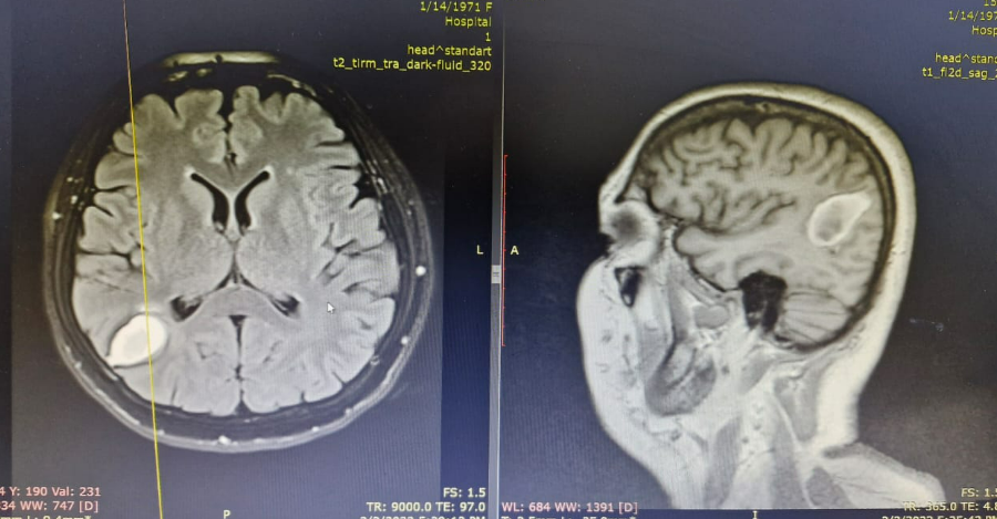 უპ­რე­ცე­დენ­ტო შემ­თხვე­ვა – თავდაპირველად სიმსივნე ეგონათ – ტვინში 15 სმ-მდე ცოცხალი სოლიტერი, რომელიც მეტასტაზი ეგონათ, ოპერაციის დროს აღმოაჩინეს | sheniekimi.ge | შენი ექიმი