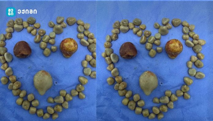 „ეს კენჭები ერთი ადამიანის ნაღვლის ბუშტიდან ამოვიღეთ. არ ეთამაშოთ ჯანმრთელობას