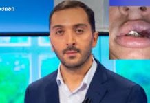 „მსგავსი ტიპის პროცედურების ჩატარება სახიფათოა – სულ რამდენიმე თვის წინ გვქონდა ორი შემთხვევა – ვეტერინარიაში გამოყენებადი პრეპარატით“ – ბიძინა კულუმბეგოვი გვაფრთხილებს "E ვიტამინით ტუჩის აუგმენტაცია დაუშვებელია… ვეტერინარიაში გამოყენებადი პრეპარატით პროცედურა მთელ სახეზე იყო ჩატარებული" - ბიძინა კულუმბეგოვი საგანგაშო ტენდენციაზე