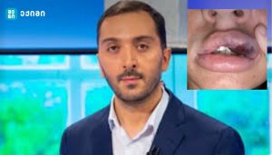 „მსგავსი ტიპის პროცედურების ჩატარება სახიფათოა – სულ რამდენიმე თვის წინ გვქონდა ორი შემთხვევა – ვეტერინარიაში გამოყენებადი პრეპარატით“ – ბიძინა კულუმბეგოვი გვაფრთხილებს