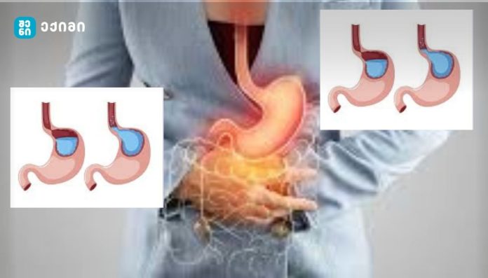 რა არის რეფლუქსი და რით განსხვავდება ის უბრალოდ გულძმარვისგან? რა იწვევს რეფლუქსს ყველაზე ხშირად? როდის უნდა მივმართოთ ექიმს? როგორია სწორი მკურნალობა?