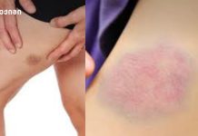 მნიშვნელოვანი დიაგნოსტიკური სიგნალია – კიდურებზე სილურჯეები – სისხლჩაქცევები, რომლებიც ტრავმებთან არ არის დაკავშირებული მნიშვნელოვანი დიაგნოსტიკური სიგნალია - კიდურებზე სილურჯეები - სისხლჩაქცევები, რომლებიც ტრავმებთან არ არის დაკავშირებული