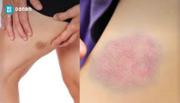 მნიშვნელოვანი დიაგნოსტიკური სიგნალია - კიდურებზე სილურჯეები - სისხლჩაქცევები, რომლებიც ტრავმებთან არ არის დაკავშირებული