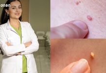 „ცხოვრება პაპილომის გარეშე მშვენიერია!“ – როგორ ვუმკურნალოთ პაპილომას Female doctor in a white coat standing confidently in a clinic; collage includes close‑ups of skin lesions on the skin sample panel.