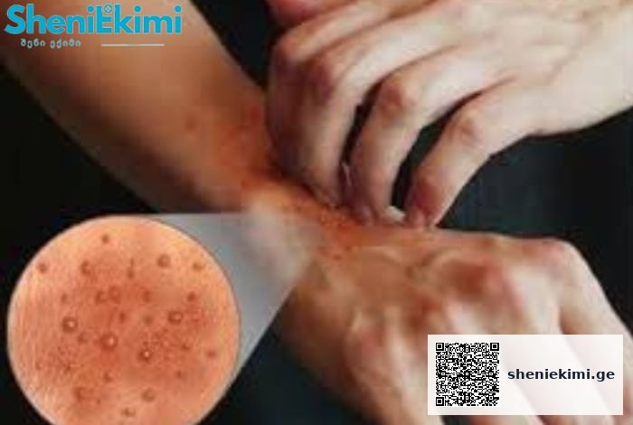 კონტაქტური დერმატიტი – კანის ანთებითი დაავადება, რომელიც ჩნდება კანზე ქიმიური ნივთიერების ზემოქმედებით | sheniekimi.ge | შენი ექიმი