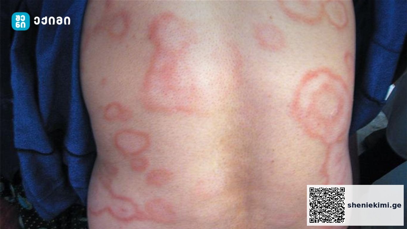 კეთრი (Leprosy) (ლეპრა, ჰანსენის დაავადება, ლომის სახე) | sheniekimi.ge | შენი ექიმი