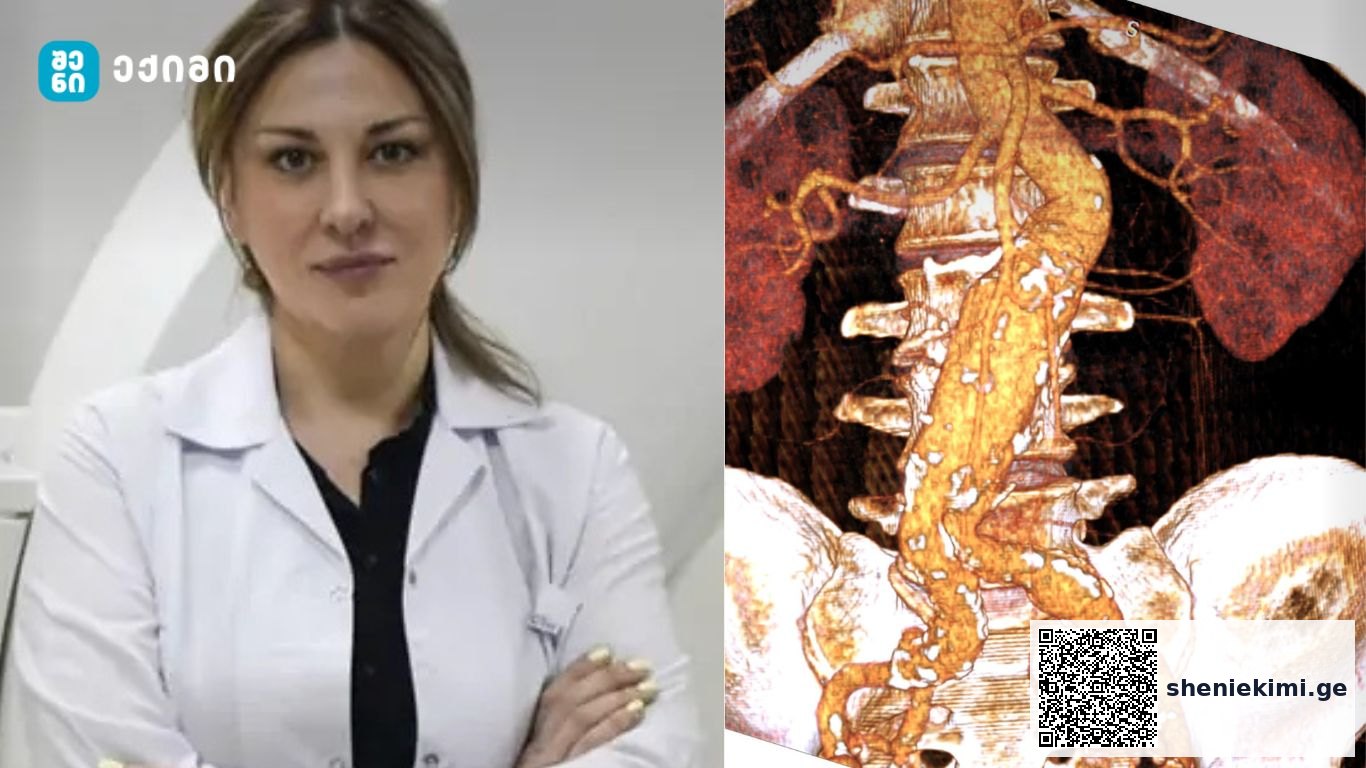 ვივამედის რადიოლოგიის სამსახურის ხელმძღვანელი მედიცინის მეცნიერებათა დოქტორი, პროფესორი თინათინ წიქორიძე – რა არის აორტის ანევრიზმა და რამდენი სახისაა იგი? | sheniekimi.ge | შენი ექიმი