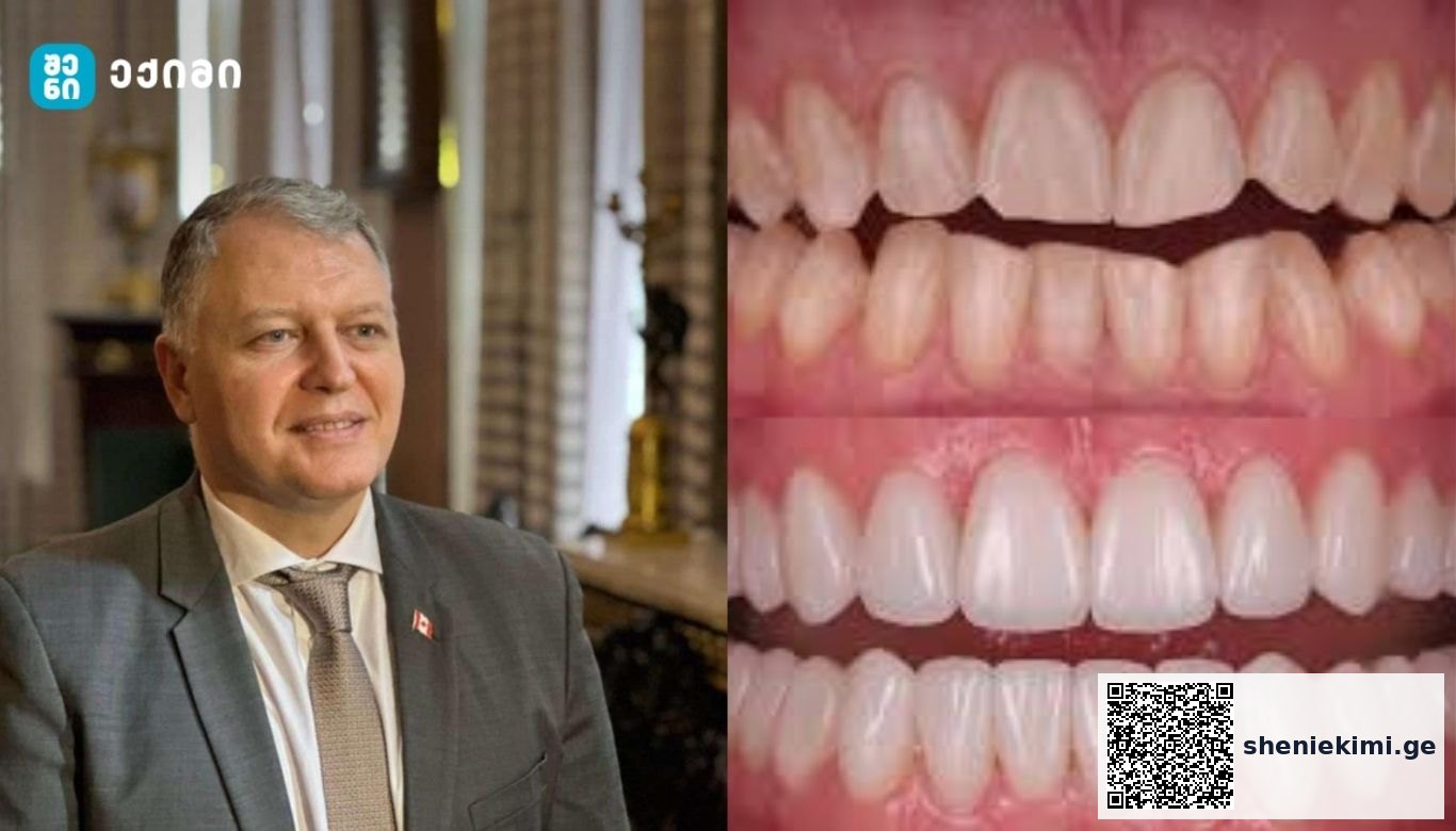 როგორ აზიანებს წონის პრეპარატი თქვენს ღრძილებსა და კბილებს? | sheniekimi.ge | შენი ექიმი