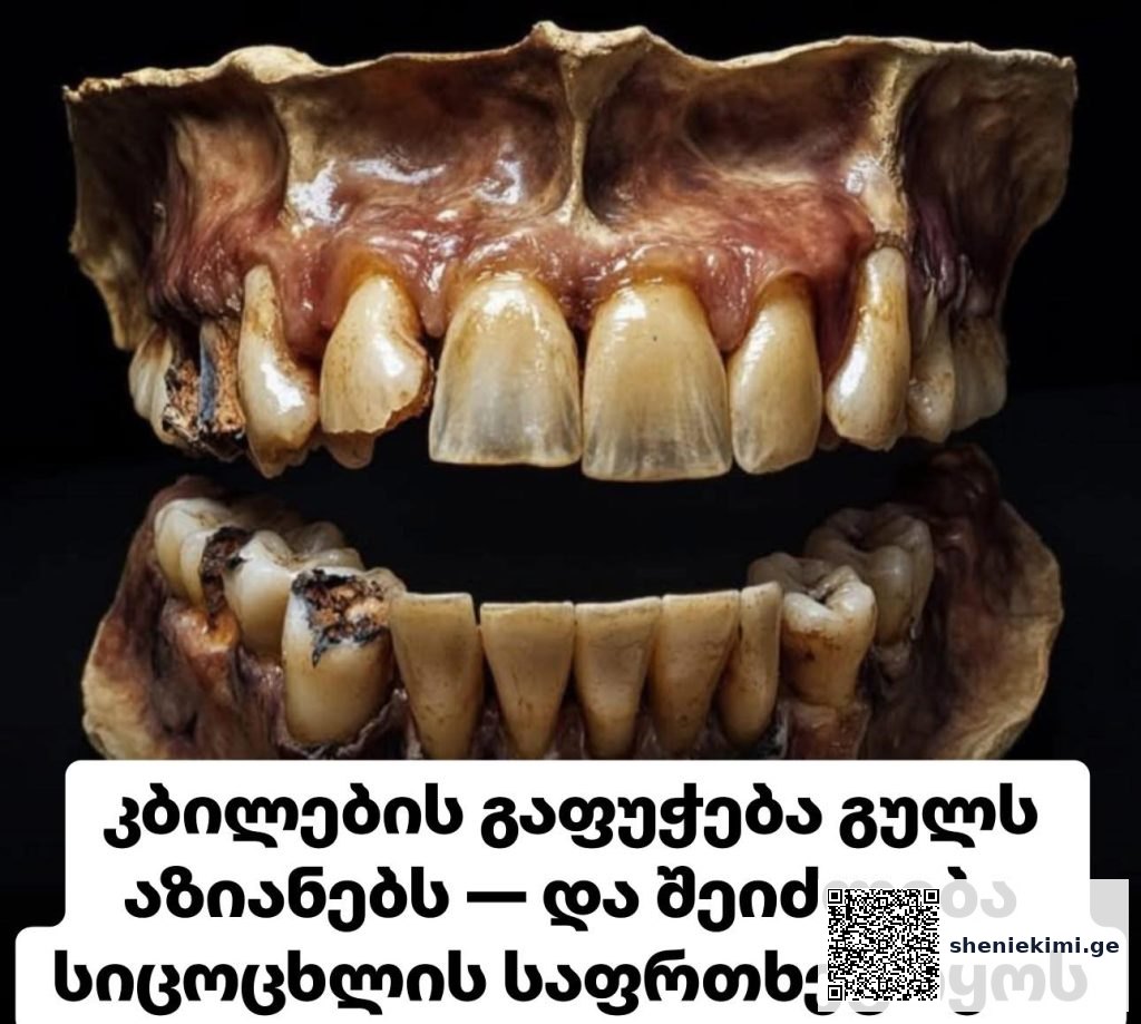 რა საერთო აქვთ კარიესს და გულის შეტევას? – კბილების გაფუჭება გულს აზიანებს — და შეიძლება სიცოცხლისთვის საფრთხეც იყოს | sheniekimi.ge | შენი ექიმი