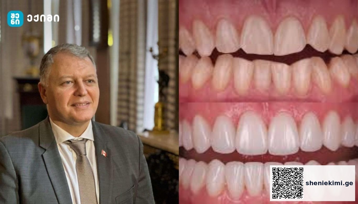 რა საერთო აქვთ კარიესს და გულის შეტევას? – კბილების გაფუჭება გულს აზიანებს — და შეიძლება სიცოცხლისთვის საფრთხეც იყოს | sheniekimi.ge | შენი ექიმი