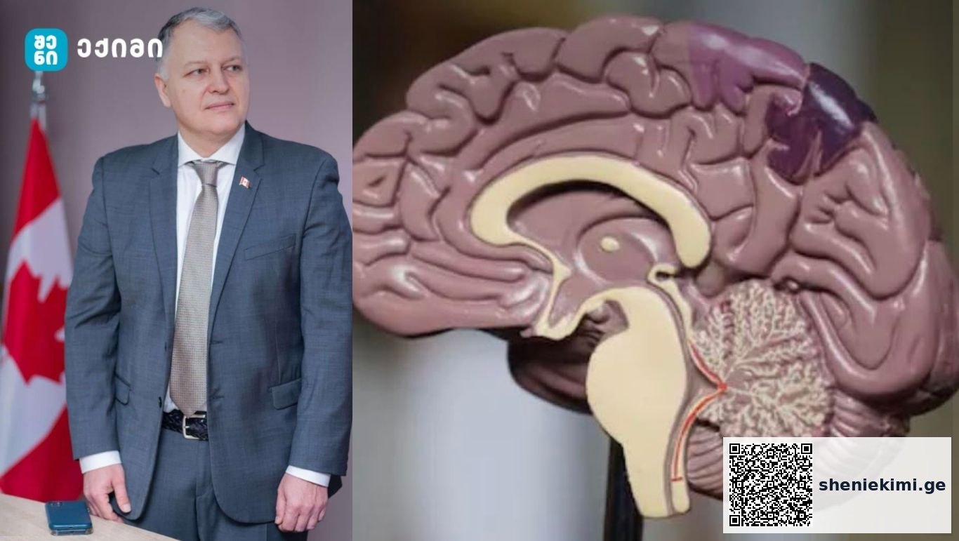 Alzheimer-ის დაავადება: მხოლოდ მეხსიერების დაკარგვა არ არის | sheniekimi.ge | შენი ექიმი